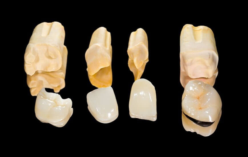 What Are Dental Crowns?