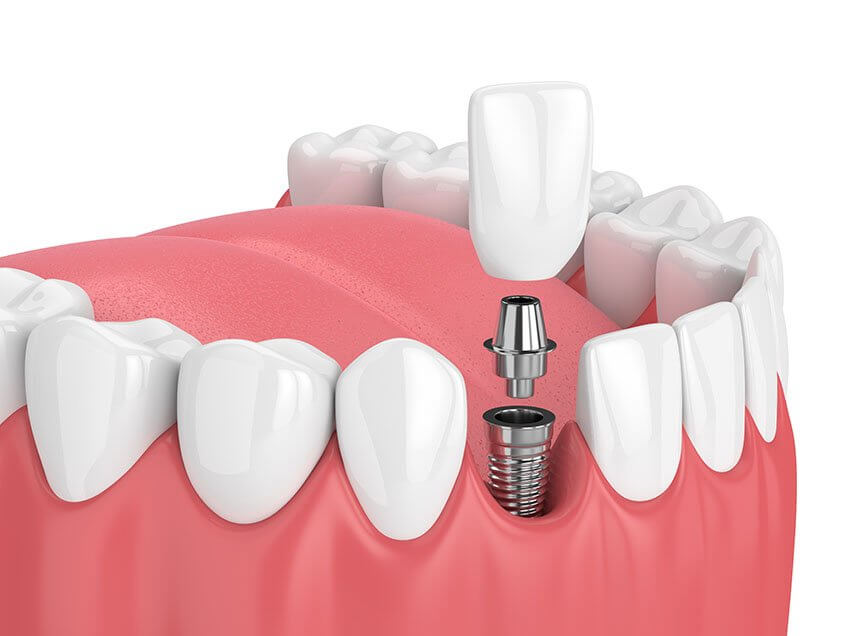 Common Misconceptions About Dental Implants
