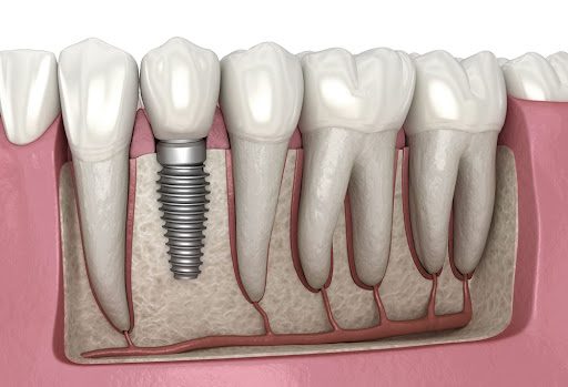 What to Expect from a Dental Implant Procedure