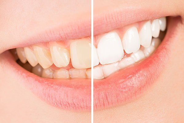 Misconceptions About Teeth Whitening